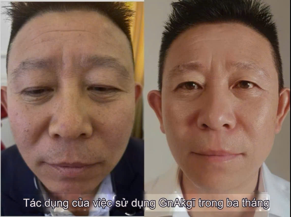 TỔNG HỢP CÁC NHÂN CHỨNG KHI DÙNG GnAKG
