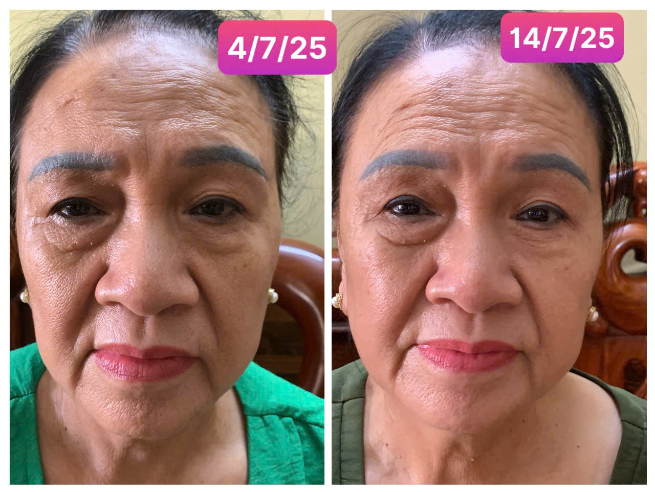 TỔNG HỢP CÁC NHÂN CHỨNG KHI DÙNG GnAKG