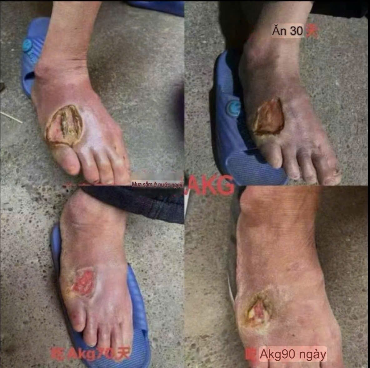 TỔNG HỢP CÁC NHÂN CHỨNG KHI DÙNG GnAKG