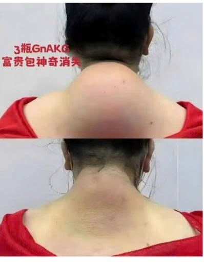 TỔNG HỢP CÁC NHÂN CHỨNG KHI DÙNG GnAKG