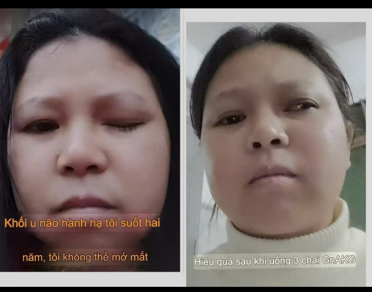 TỔNG HỢP CÁC NHÂN CHỨNG KHI DÙNG GnAKG