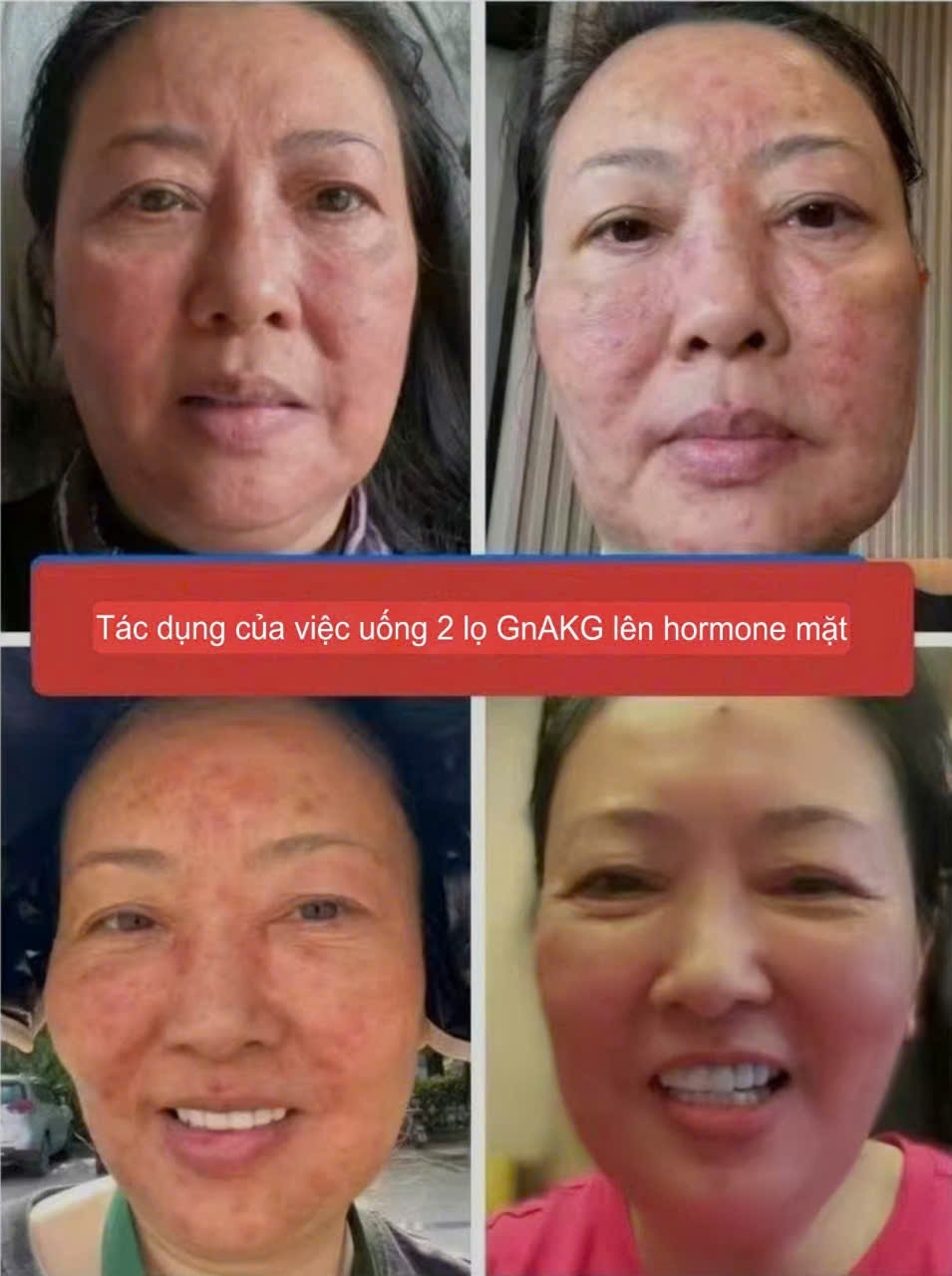 TỔNG HỢP CÁC NHÂN CHỨNG KHI DÙNG GnAKG