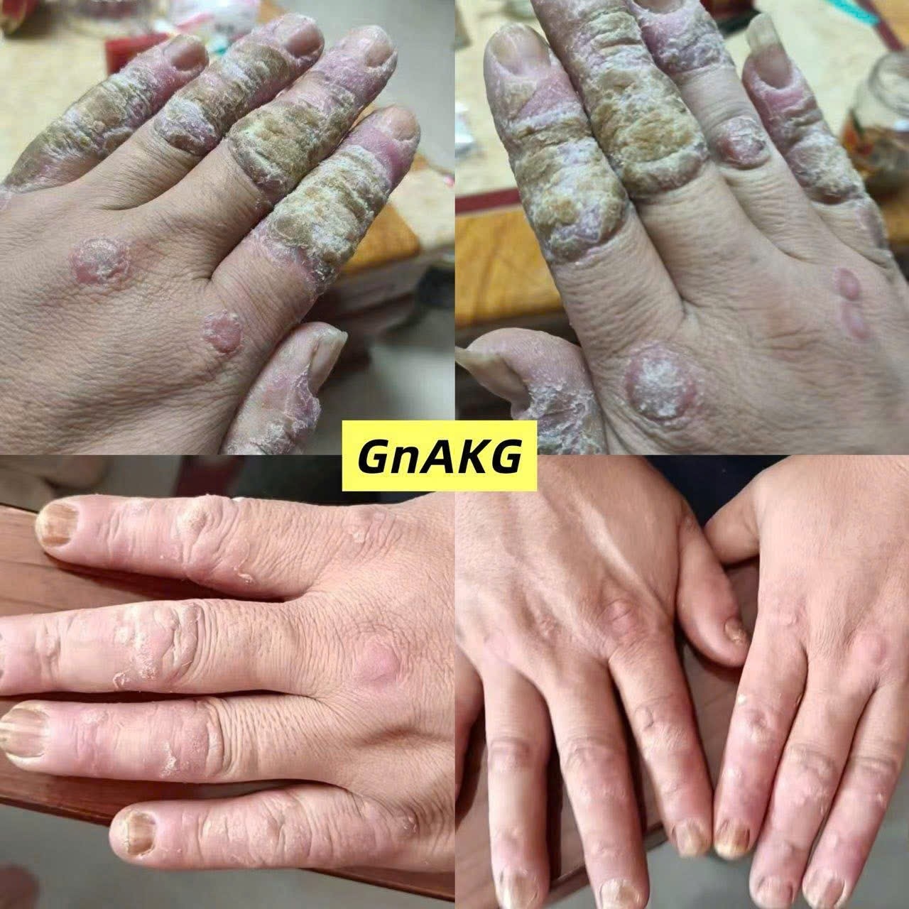 TỔNG HỢP CÁC NHÂN CHỨNG KHI DÙNG GnAKG