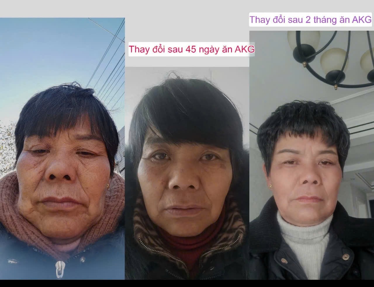 TỔNG HỢP CÁC NHÂN CHỨNG KHI DÙNG GnAKG