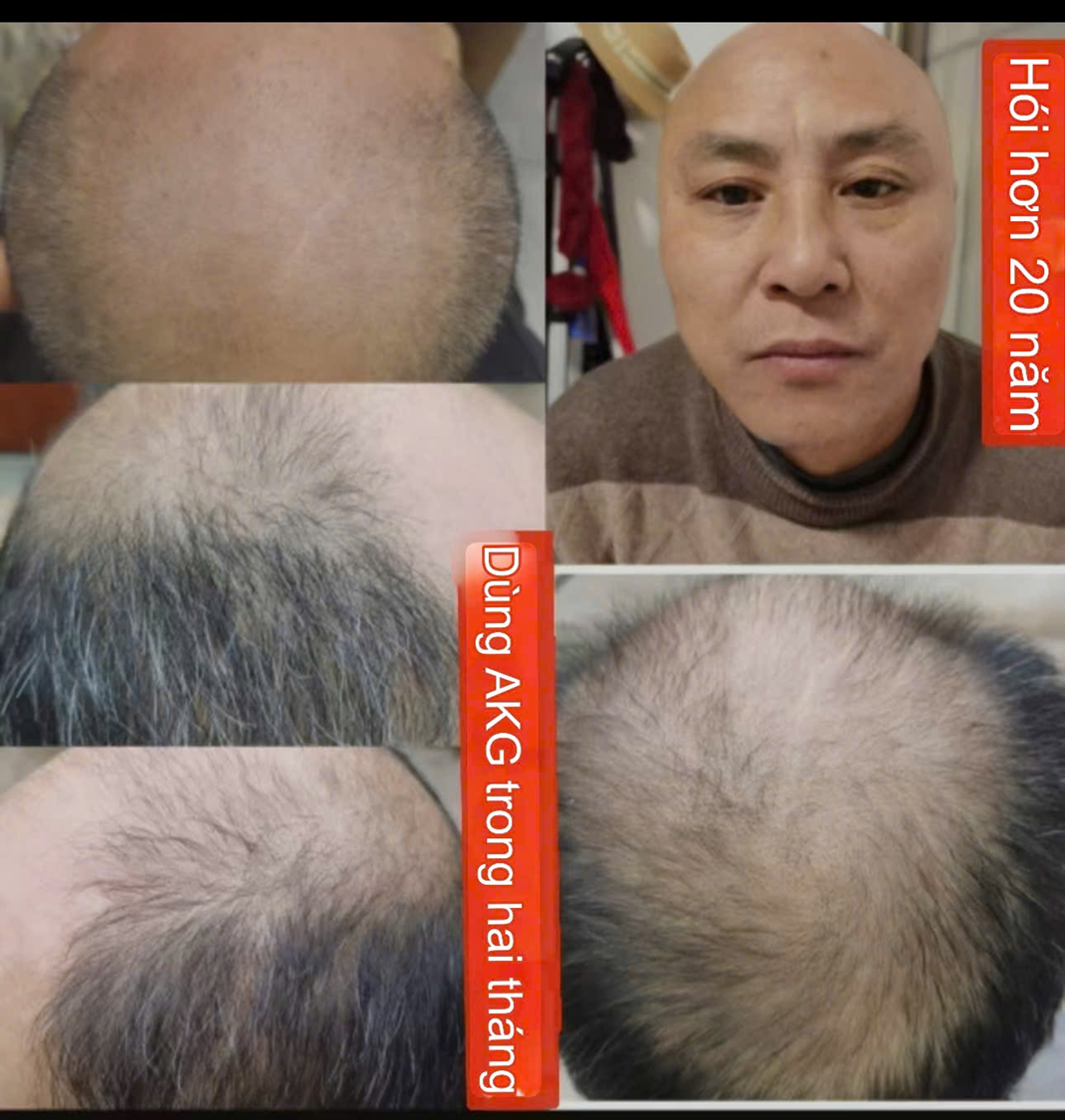 ĐẦU HÓI, TÓC BẠC CẦN BỔ XUNG GÌ