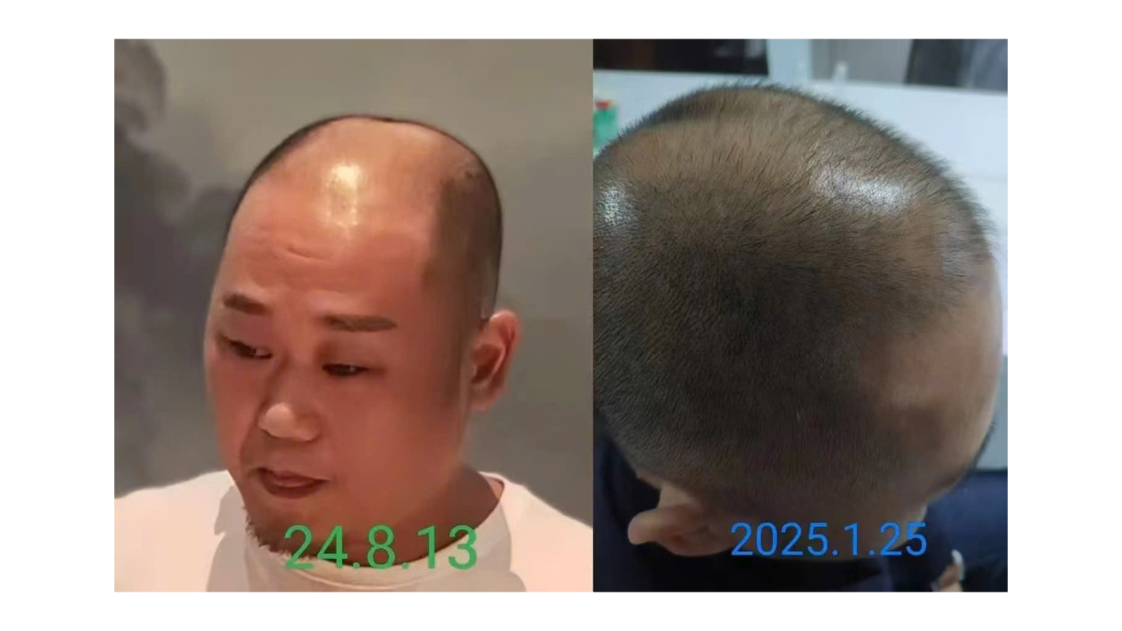 ĐẦU HÓI, TÓC BẠC CẦN BỔ XUNG GÌ