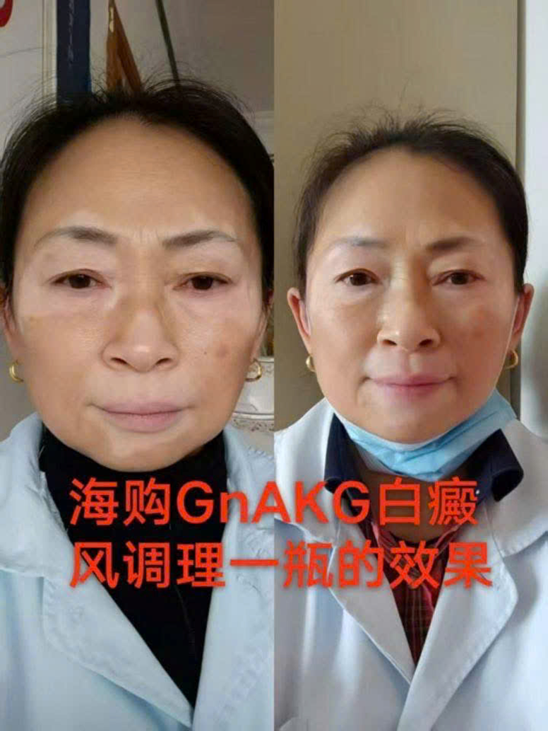 GnAKG với người bị bạch biến