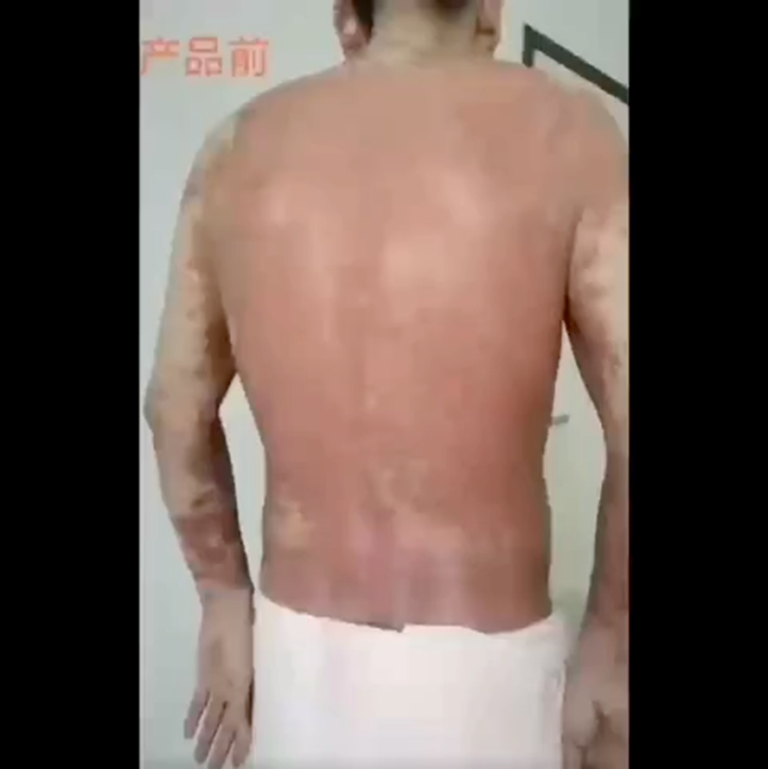 GnAKG với người bị viêm da cơ địa
