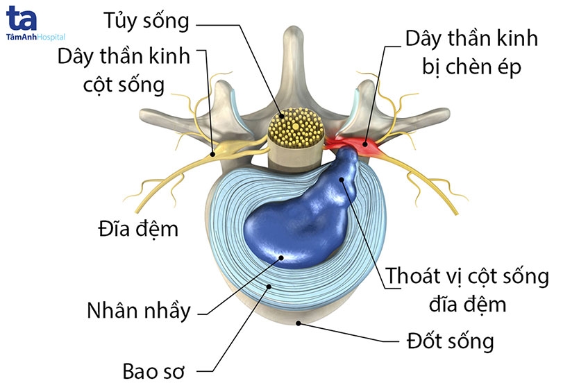 GnAKG với bệnh Thoát Vị Đĩa Đệm
