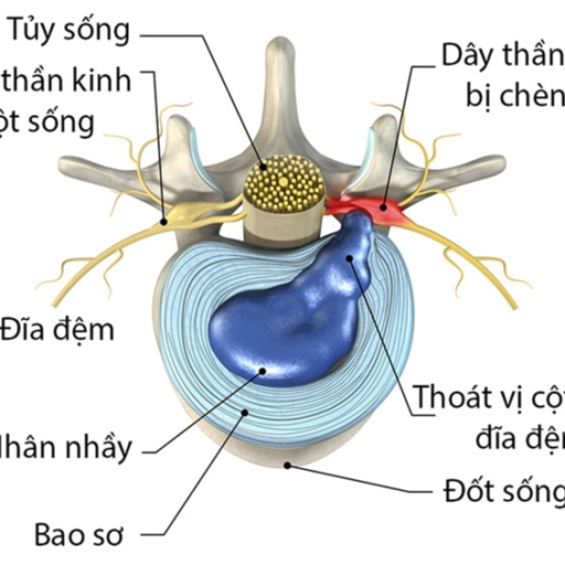 GnAKG với bệnh Thoát Vị Đĩa Đệm