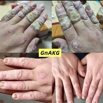 GnAKG với bệnh vảy nến GnAKG với bệnh vảy nến