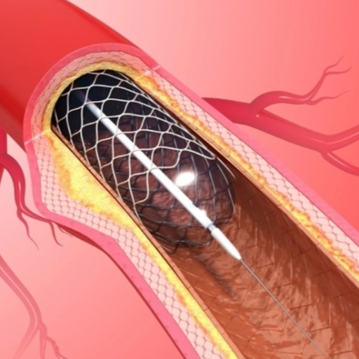  Khi nào phải đặt stent (ten)?