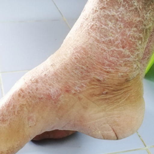 BỆNH XƠ CỨNG BÌ