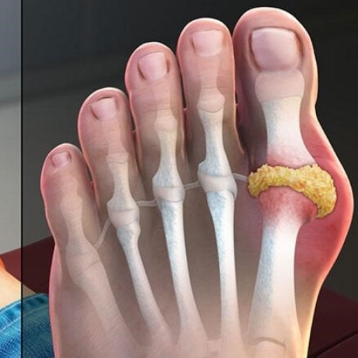 GnAKG với bệnh gút như thế nào