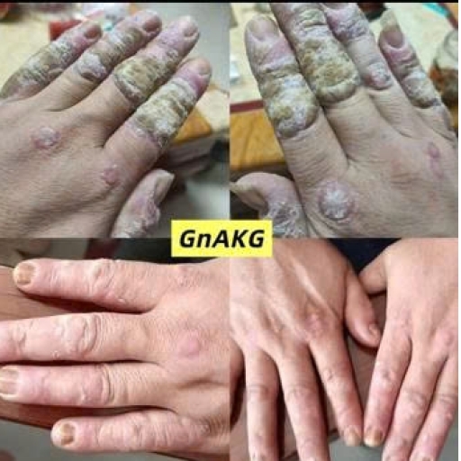 GnAKG với bệnh vảy nến