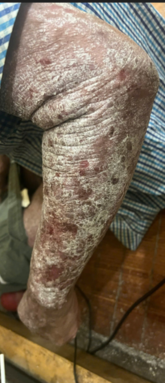 GnAKG với bệnh vảy nến GnAKG với bệnh vảy nến