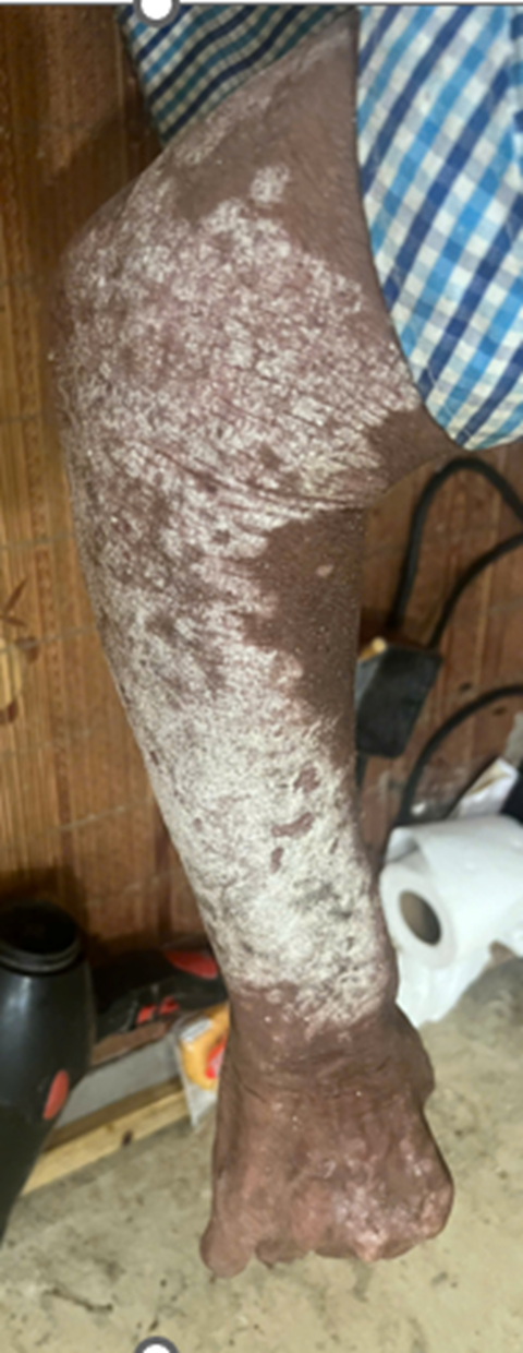 GnAKG với bệnh vảy nến GnAKG với bệnh vảy nến