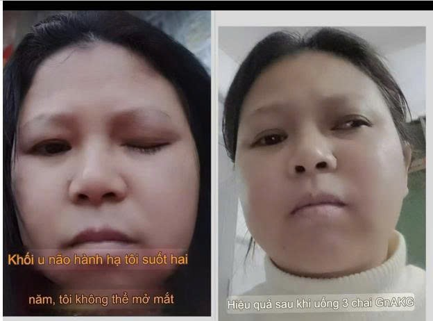 Tác dụng của GnCell với ung thư Tác dụng của GnCell với ung thư