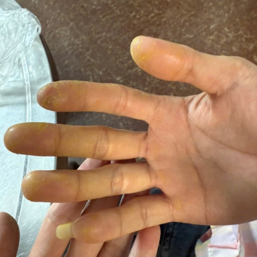 Bệnh tổ đỉa với GnAKG và GnCell