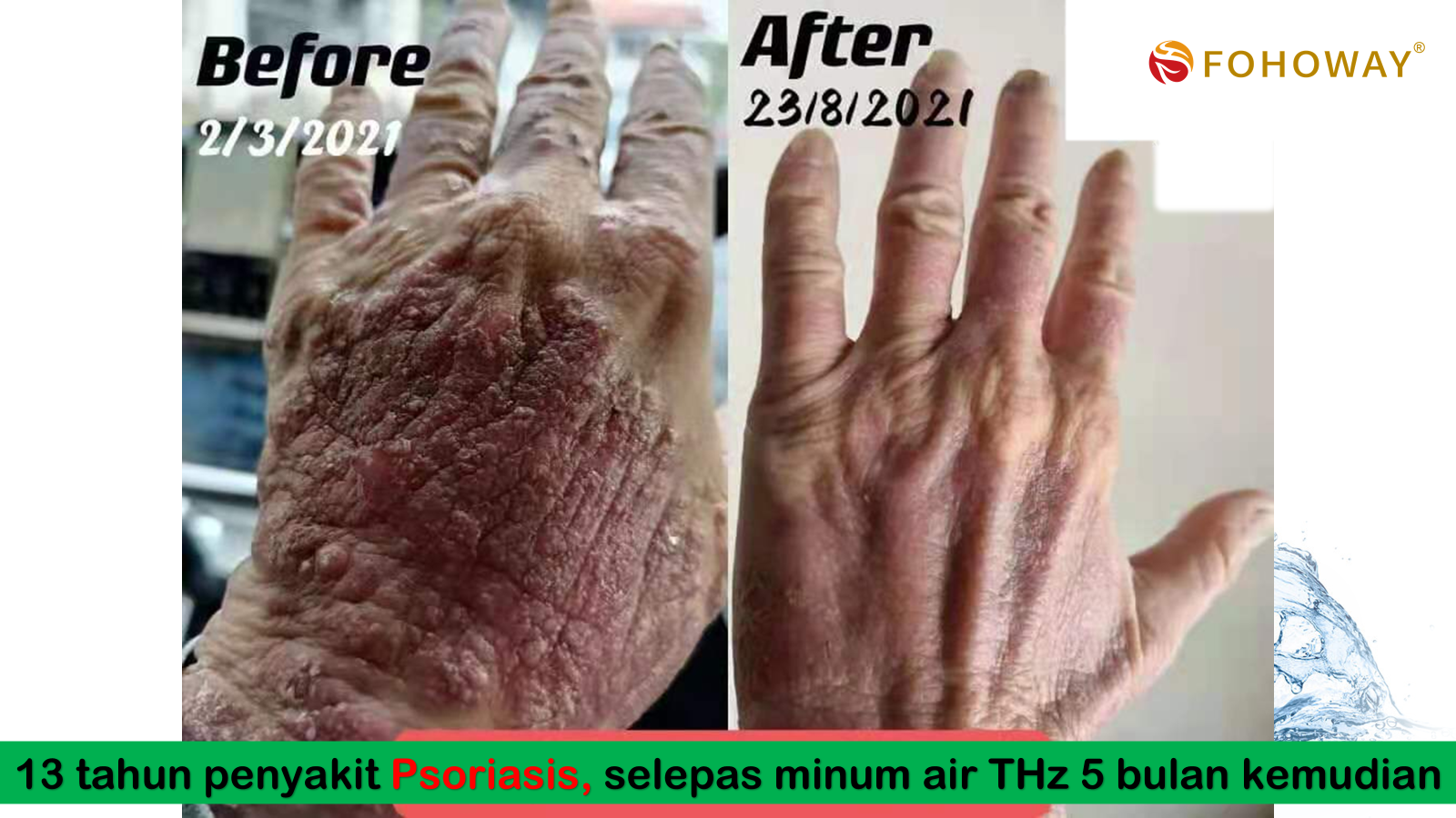 Ca tách nước Siêu phân tử nhỏ 