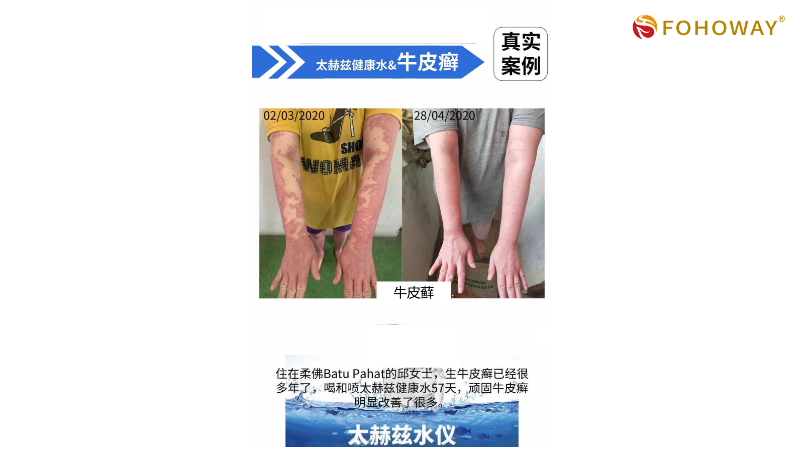 Ca tách nước Siêu phân tử nhỏ 