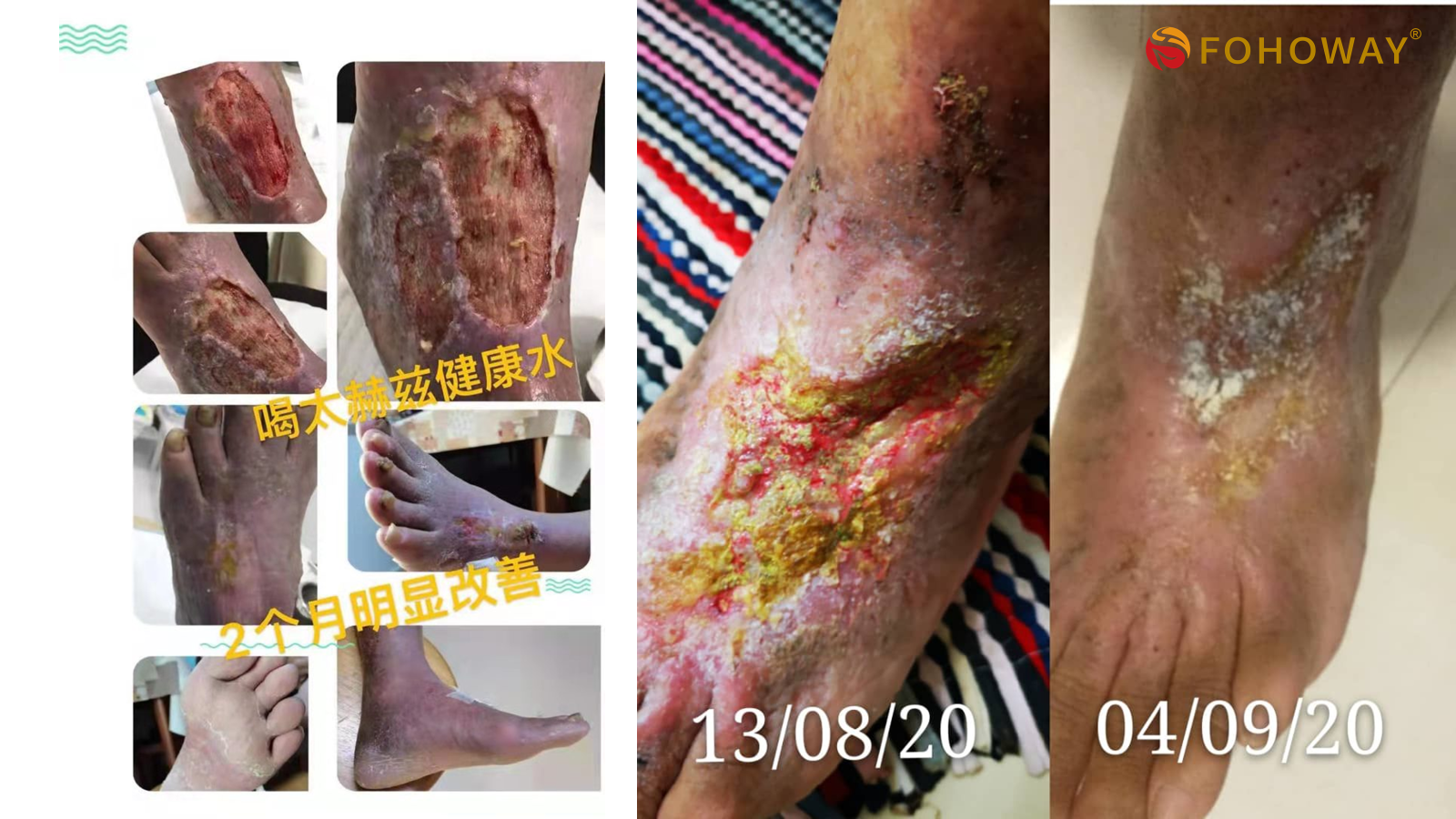 Ca tách nước Siêu phân tử nhỏ 