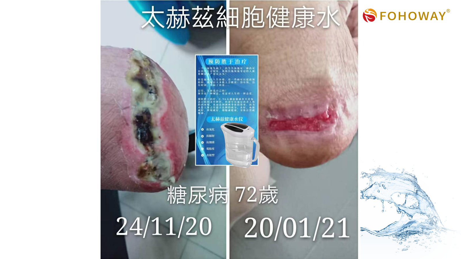 Ca tách nước Siêu phân tử nhỏ 