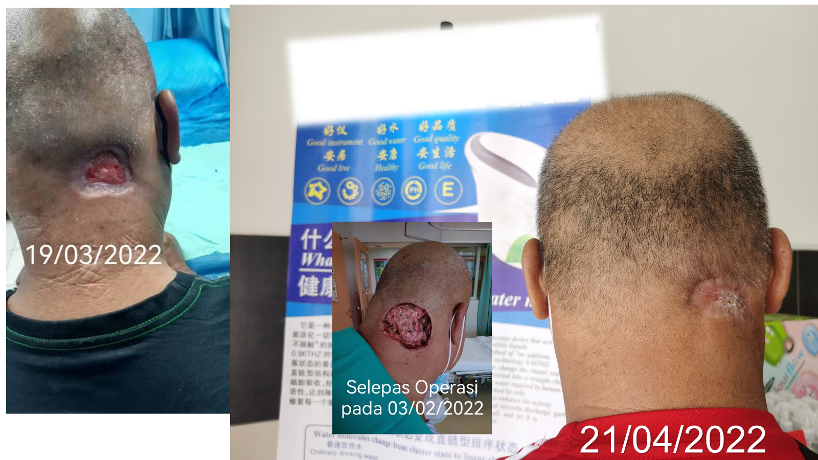 Ca tách nước Siêu phân tử nhỏ 